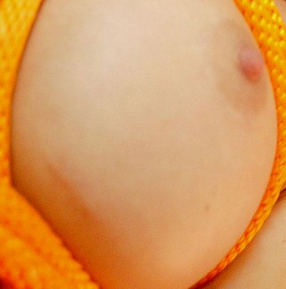 breast augmentation scar closeup