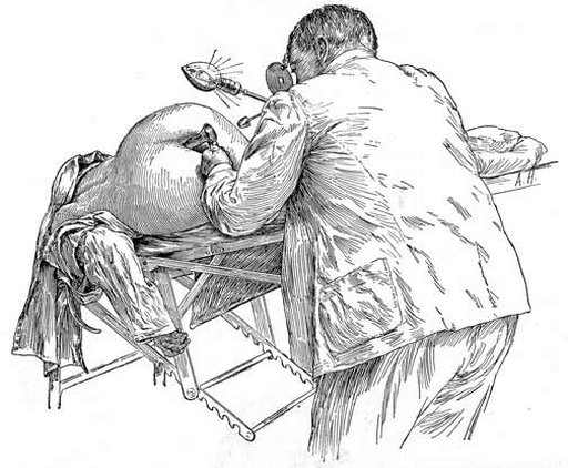 drawing from medical text of a woman getting a pelvic/vaginal exam with speculum while in the Sims position