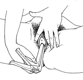 speculum insertion