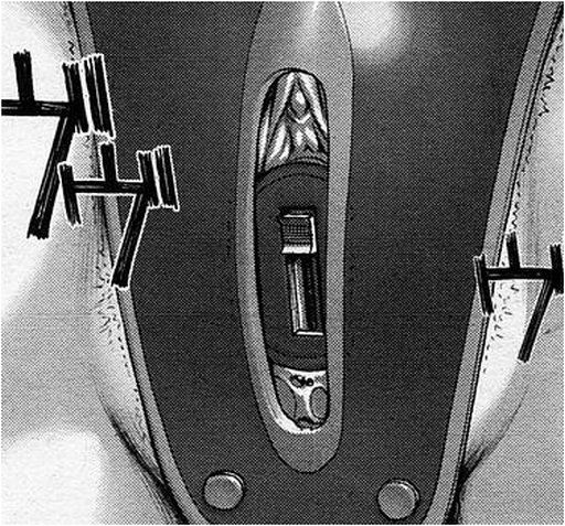vibrator inside a chastity belt