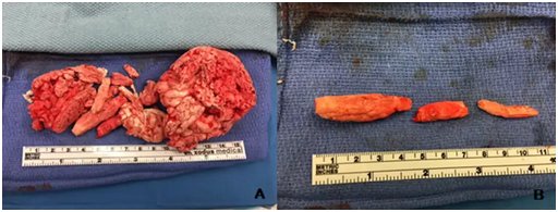 foam removed from dick and bladder